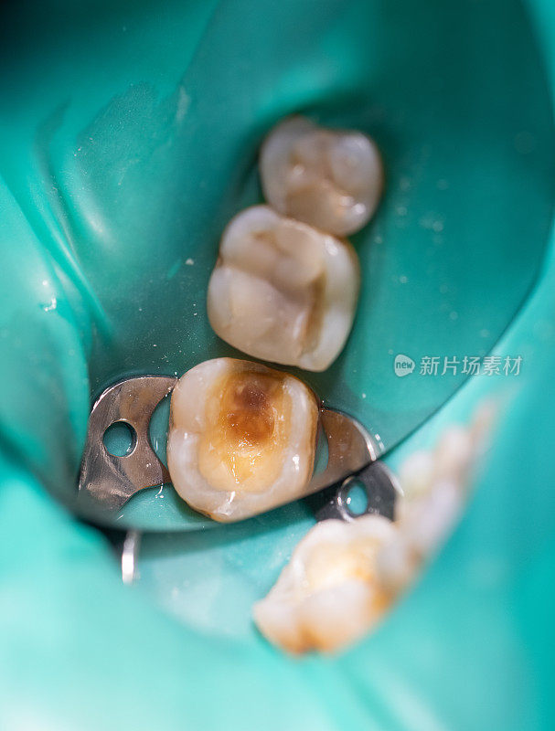 近距离牙髓治疗。清洁牙根及其填充物。现代技术在牙科诊所的概念