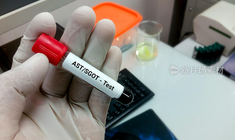 血样作AST或SGOT检查。肝功能测试。血清glutamic-oxaloacetic转氨酶。天冬氨酸转氨酶