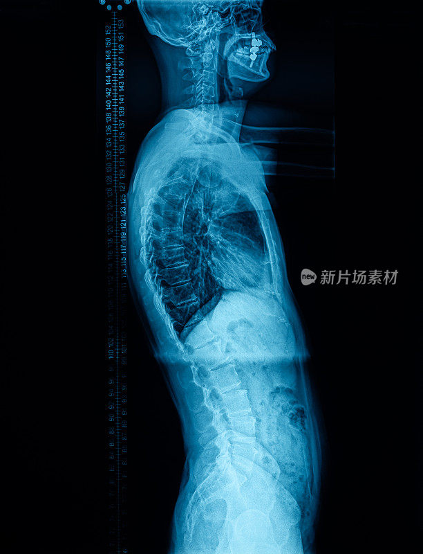 人体脊柱侧视x光片