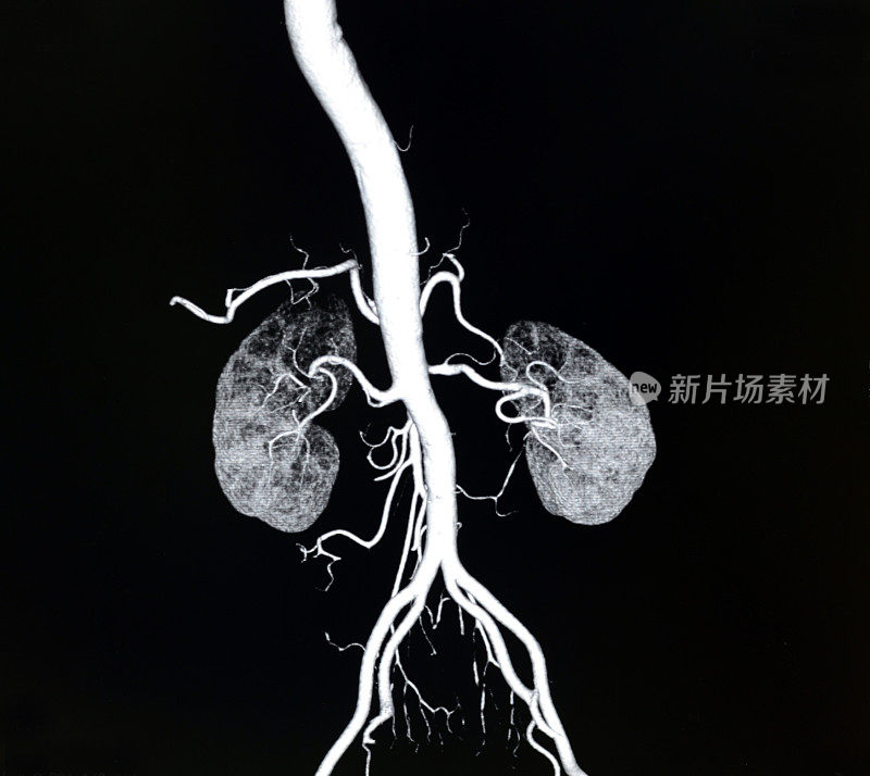 主动脉和肾动脉CT容积显示