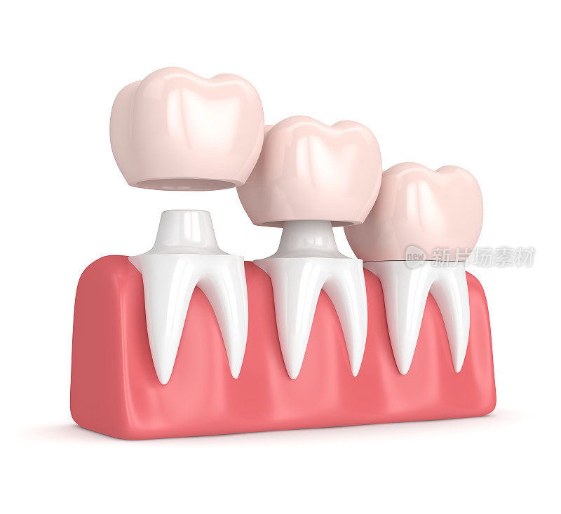 3d渲染的替换冠胶结在重塑的牙齿上