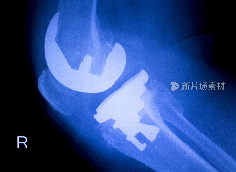 膝关节骨科植入物x线扫描