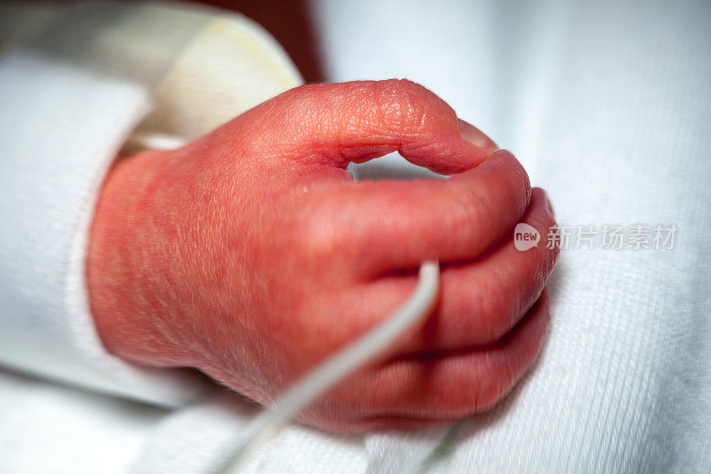 新生儿重症监护室早产儿的手