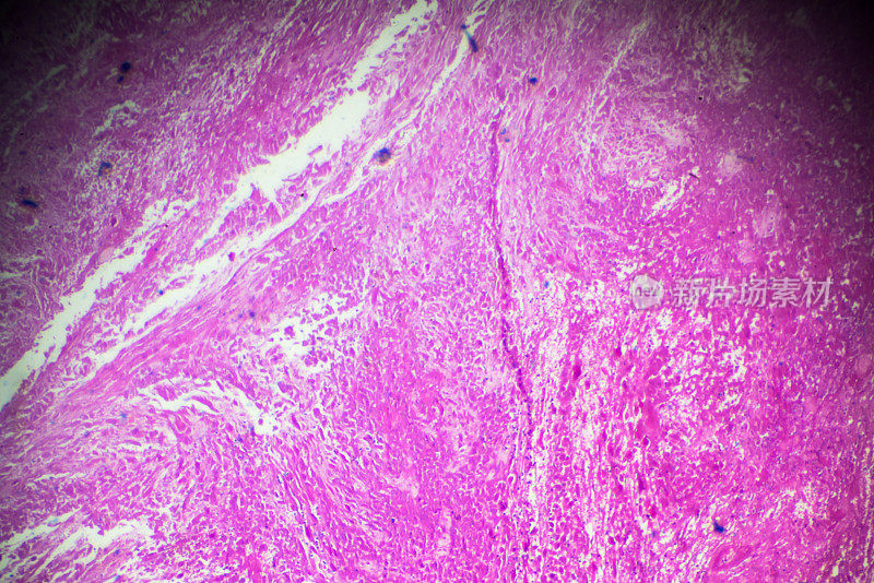 绒毛膜癌活检显微镜下