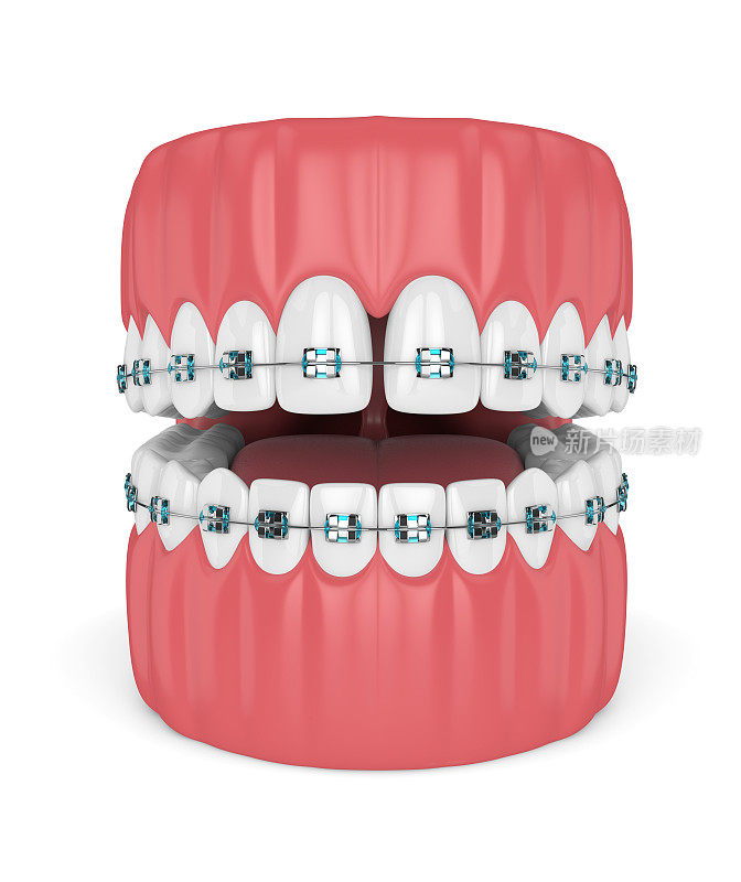 牙齿与牙套和牙套的3d渲染