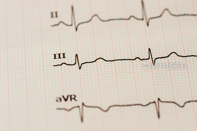 图表心电图(ECG)