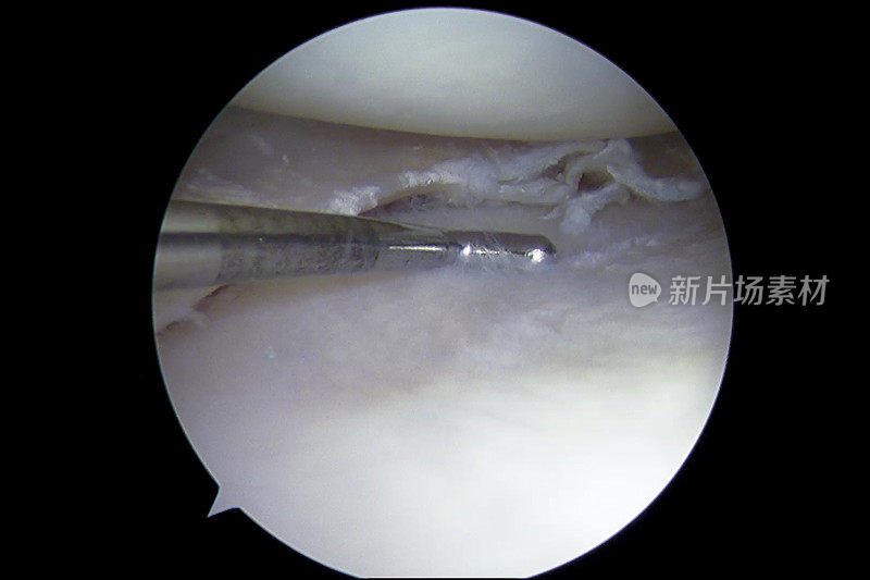 膝关节骨性关节炎和退行性半月板撕裂的关节镜观察