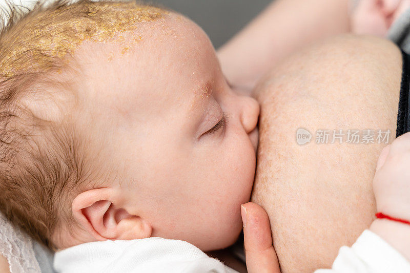 婴儿男孩有脂溢性皮炎皮肤病问题吃了母亲的母乳喂养近照