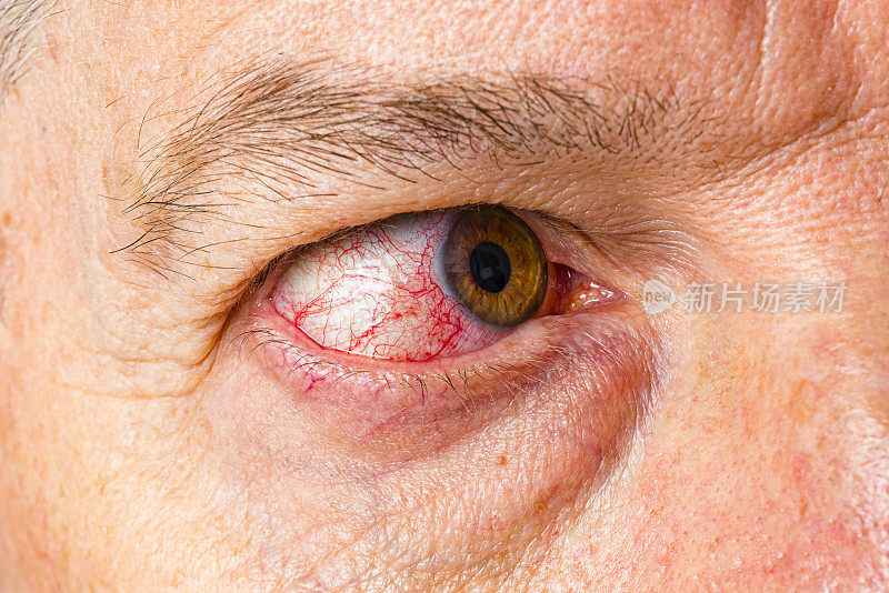 患有结膜炎或红眼病的成人眼球