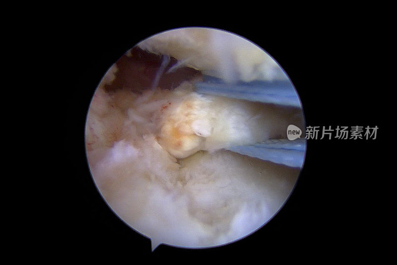 后半月板根骨撕脱性骨折