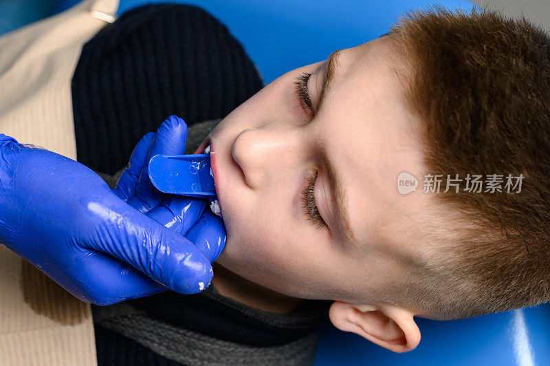 带硅胶诊断模型的颌骨印模，儿童歪牙。