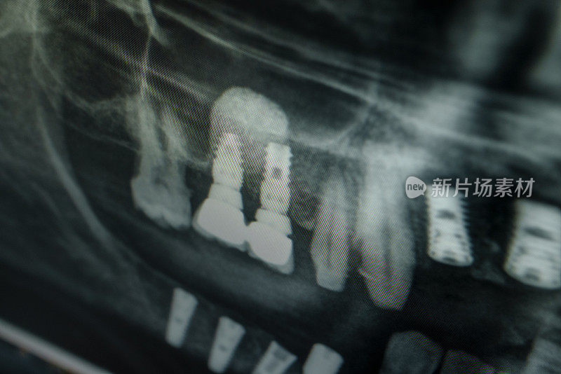 全景x线摄影(正位断层摄影)，显示牙齿结构的x光片