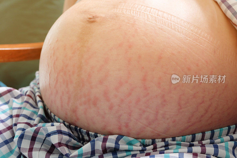 妊娠期拉伸痕皮肤