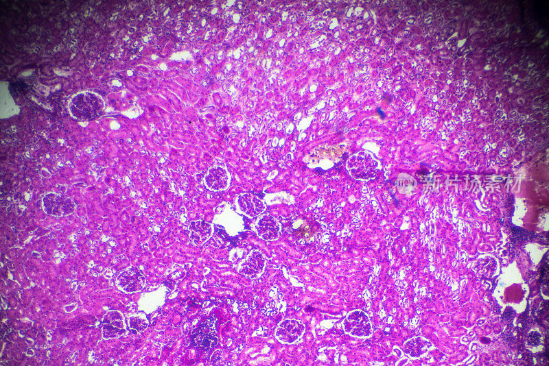 显微镜下急性肾盂肾炎活检标本