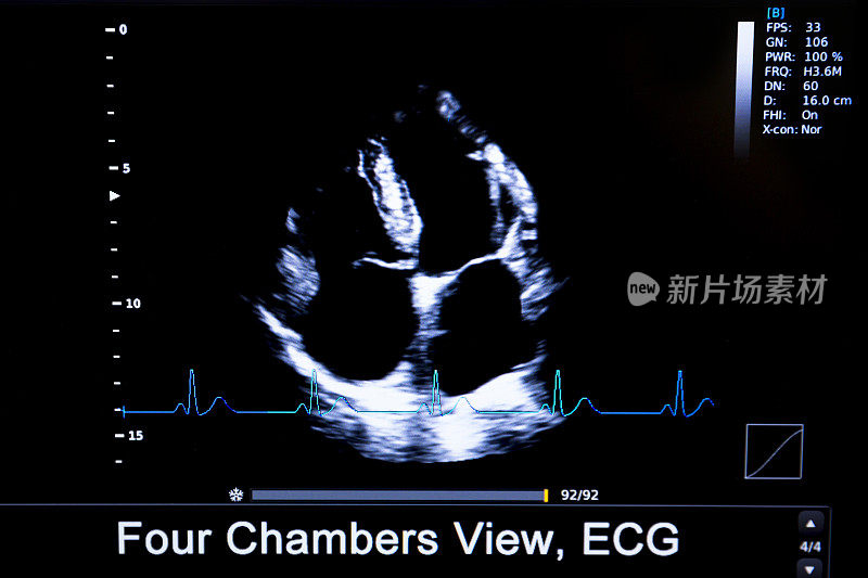 彩色人体心脏超声监测仪图像