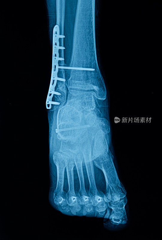 人体腿部和足部x光图像