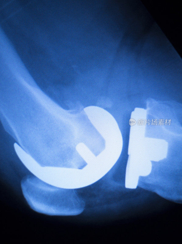 膝关节植入物x线检查扫描