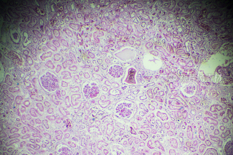 显微镜下急性肾炎活检标本