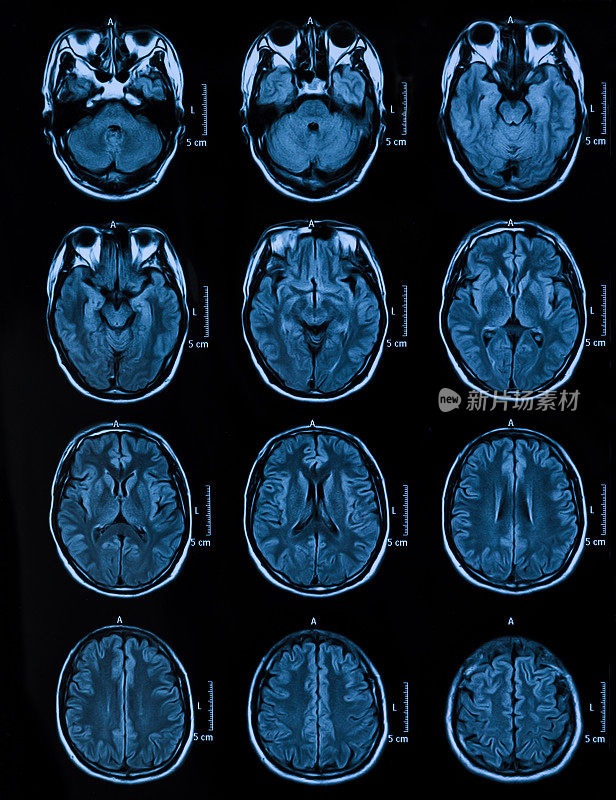 MRI扫描人类头部断层扫描
