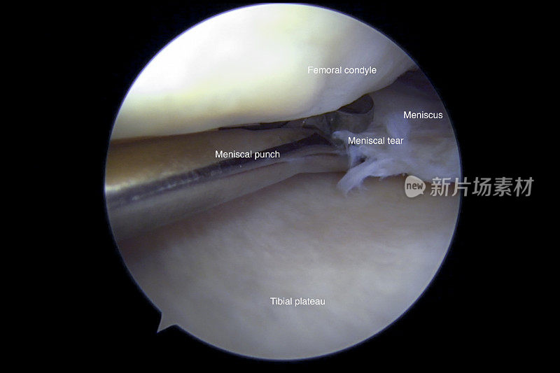 左膝内侧半月板后部复杂退行性撕裂的关节镜观察
