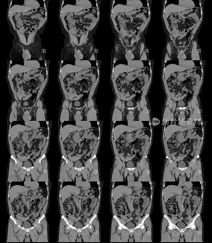 腹部骨盆Cat扫描正面视图