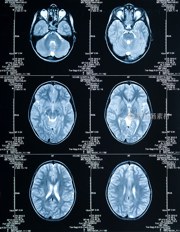 MRI脑部扫描显示头部和头骨的多个图像