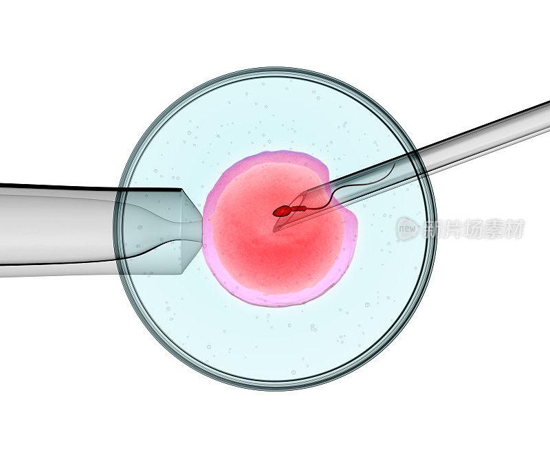 icsi(胞浆内精子注射)过程的3D渲染——将单个精子直接注射到卵子中