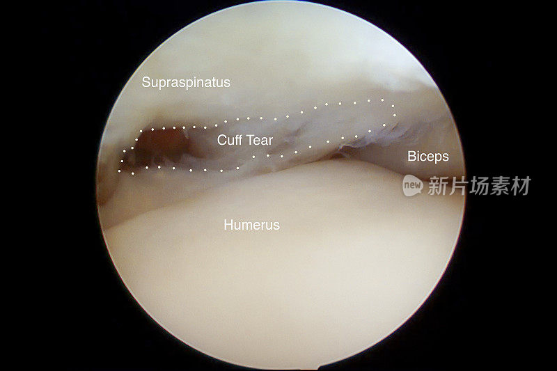 肩关节镜下观察肩袖撕裂