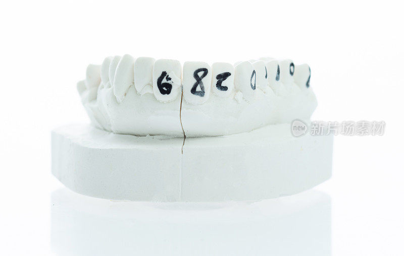 人类牙齿的石膏模型