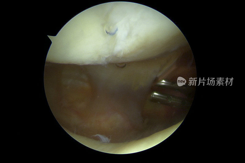 膝关节镜下观察膝关节软骨缺损或膝盖骨病变