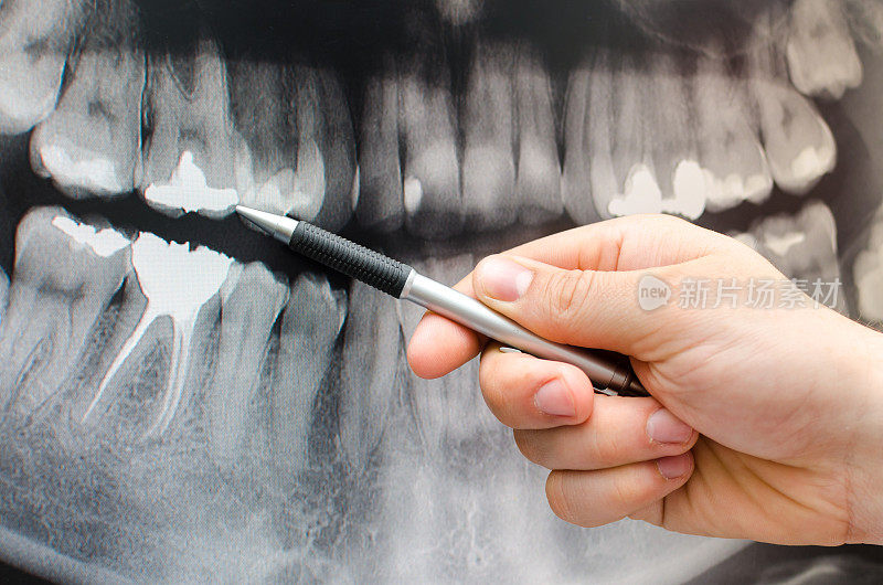 牙科医生在牙科x光图像上显示了一些东西