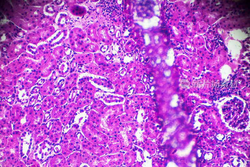 显微镜下急性肾盂肾炎活检标本