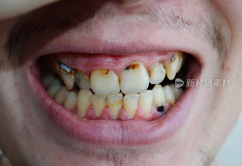 口腔保健，龋齿，牙垢，牙龈疾病，牙齿问题，坏牙，牙齿问题，牙科