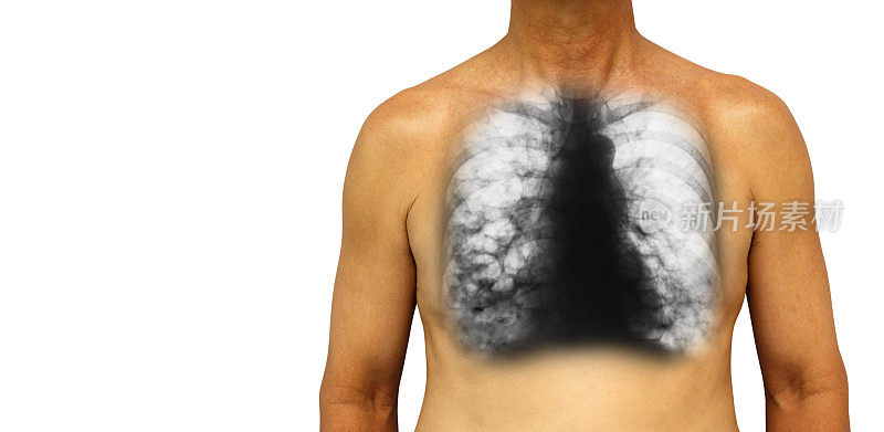 支气管扩张。胸部x光片显示慢性感染引起的多发肺泡和囊肿。孤立的背景。左侧空白区域