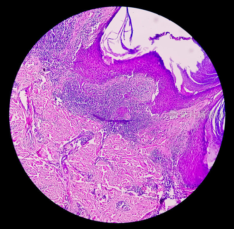 子宫内膜癌认识:子宫活检显微照片显示子宫内膜癌或子宫内膜癌。
