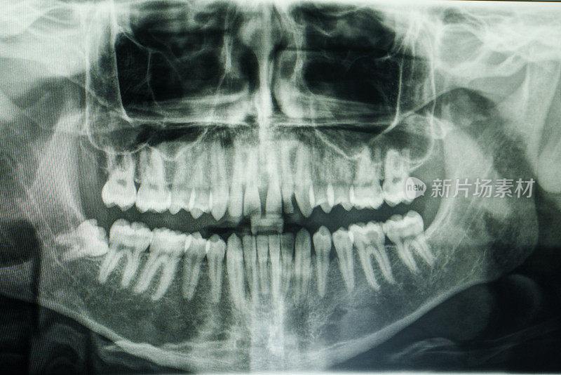埋藏智齿的x光图像