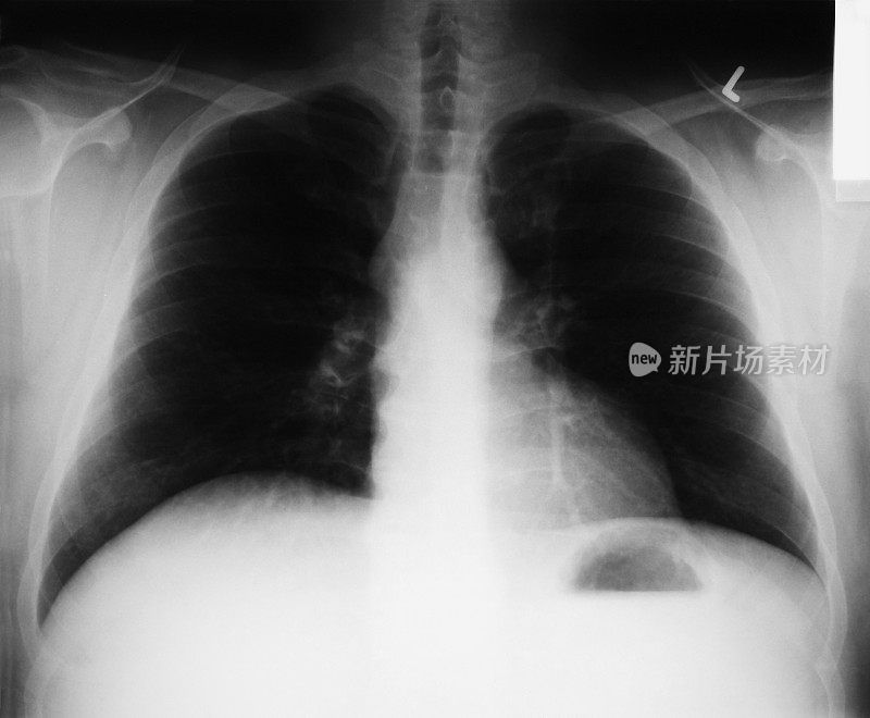 人体胸部x光片