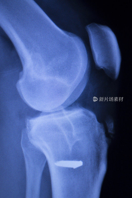 膝关节损伤螺钉植入物x线扫描