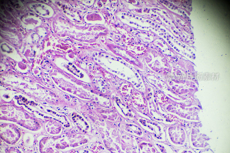 显微镜下急性肾炎活检标本