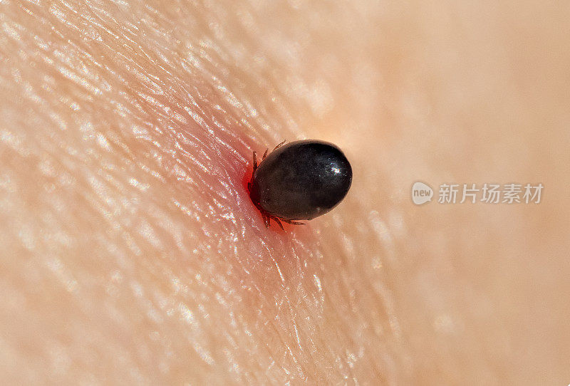 蓖麻虫寄生在人类皮肤上