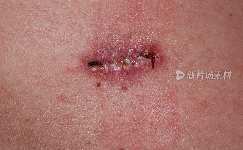 切除背部皮肤癌后的疤痕。