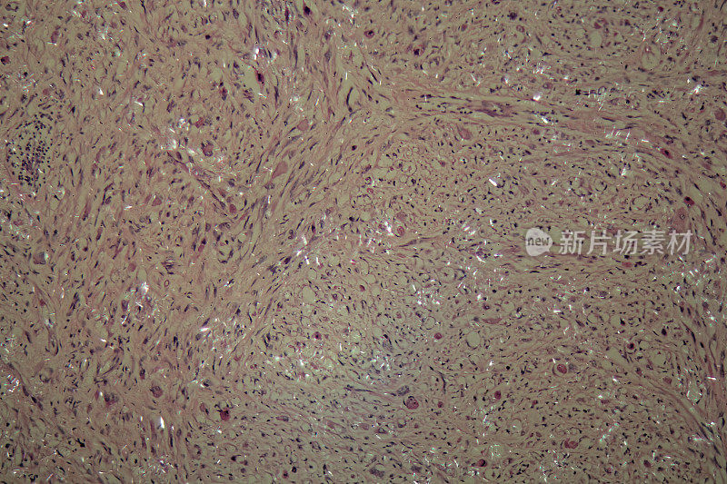 睾丸癌细胞