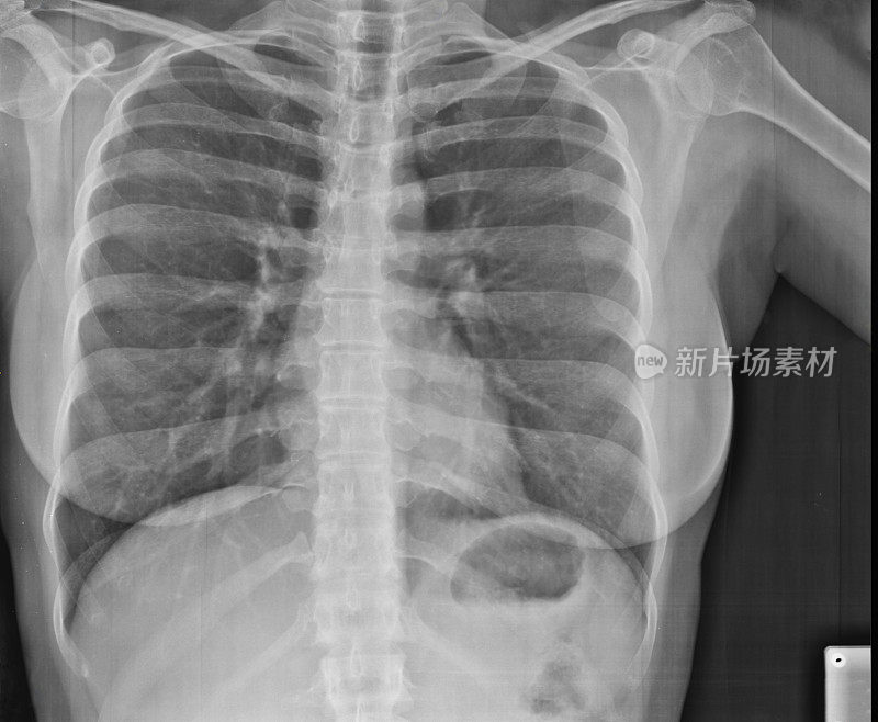 人体胸部x线影像