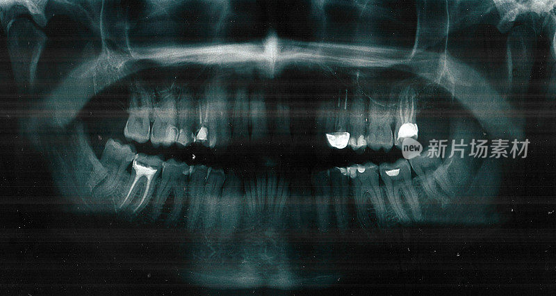 口腔全景x光片