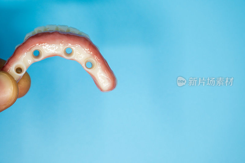 假牙模型附着于下颌种植体治疗