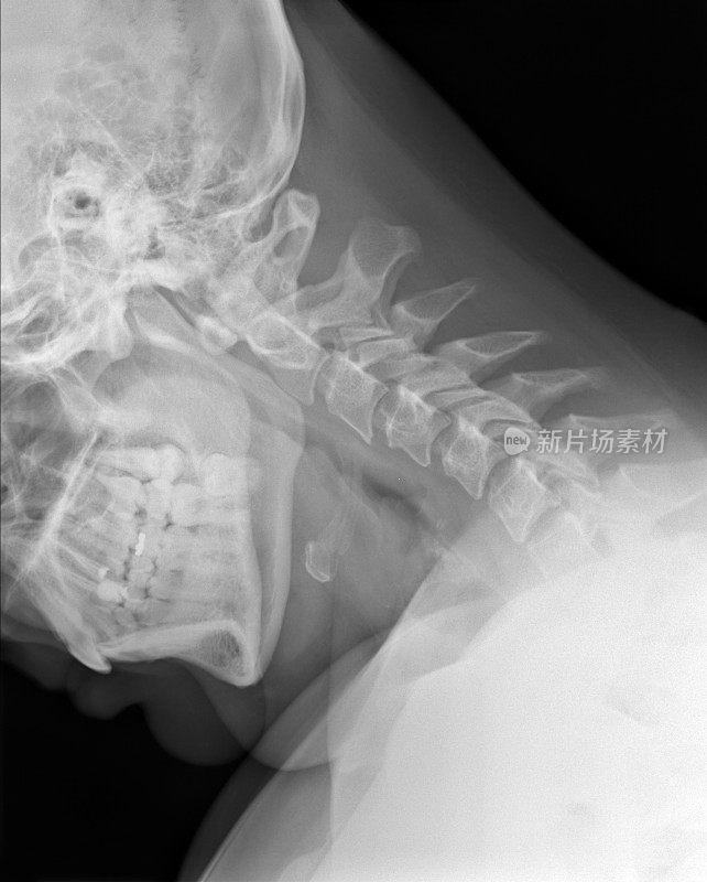 颈椎x光片