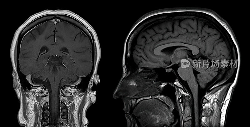 CT脑部核磁共振成像(MRI)