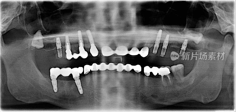 牙科x光检查含种植体的牙齿