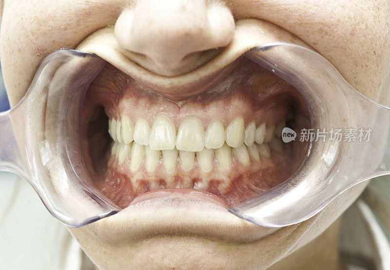 牙科医生的牙齿
