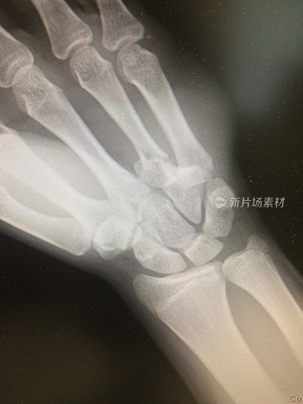 手骨折x线片，AP视图